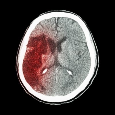 infarto cerebral